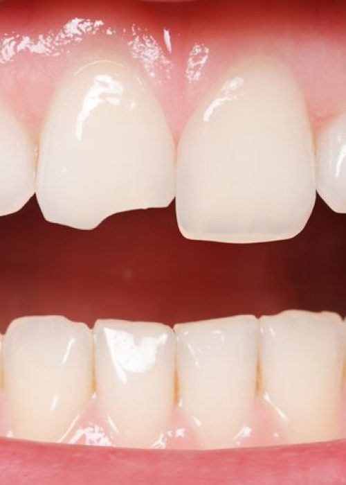 Restorative Dentistry. ID. Dental Implants, Porcelain Veneers, ClearCorrect, Teeth Whitening in Nashville, TN 37205 Call:615-268-6522 cosmetic dental bonding dental bonding